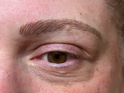 Micropigmentation after eyebrow procedure