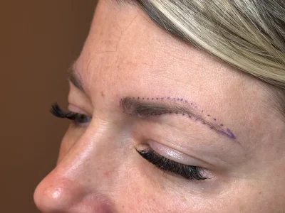 Micropigmentation before eyebrow procedure