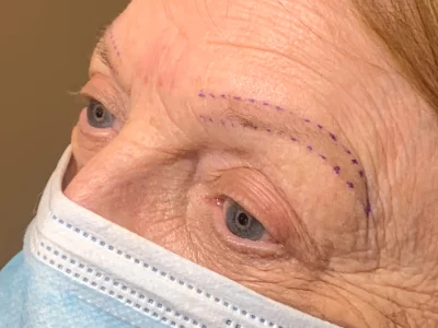 Micropigmentation before eyebrow procedure