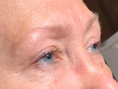 Micropigmentation before eyebrow procedure