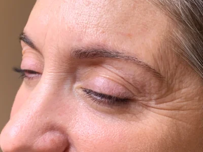 Micropigmentation before eyebrow procedure