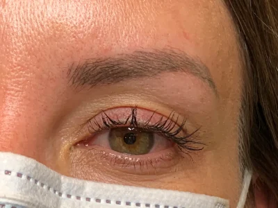 Micropigmentation healed eyebrow procedure