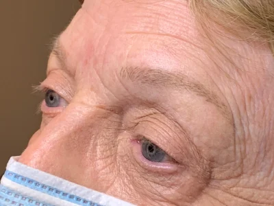 Micropigmentation healed eyebrow procedure