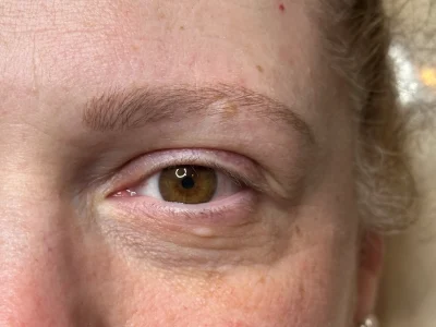 Micropigmentation before eyebrow procedure