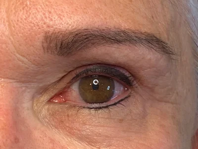 Micropigmentation after eyeliner procedure