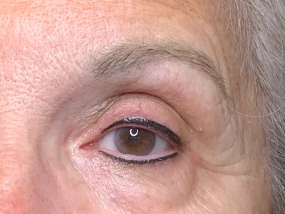Micropigmentation after eyeliner procedure