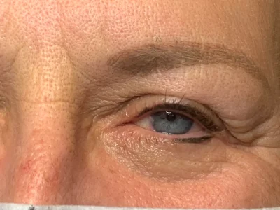 Micropigmentation after eyeliner procedure