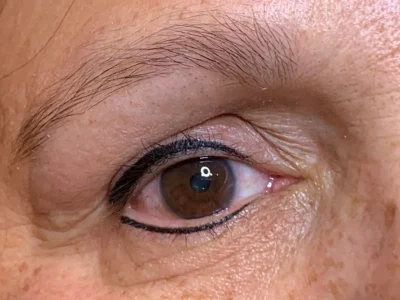 Micropigmentation after eyeliner procedure