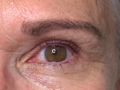 Micropigmentation before eyeliner procedure