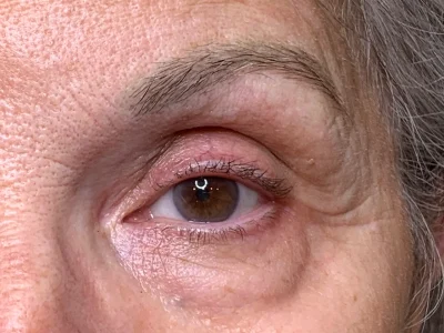 Micropigmentation before eyeliner procedure