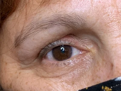 Micropigmentation before eyeliner procedure
