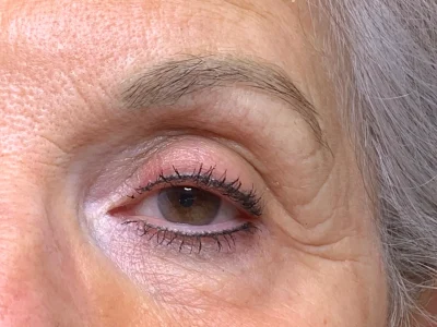 Micropigmentation healed eyeliner procedure