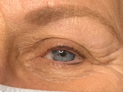 Micropigmentation healed eyeliner procedure