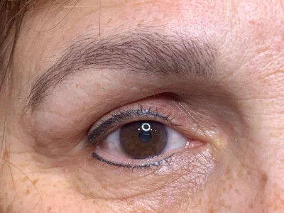 Micropigmentation healed eyeliner procedure