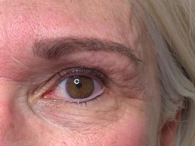 Micropigmentation healed eyeliner procedure